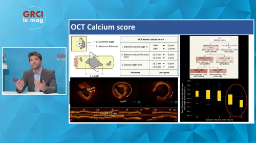 L'angioplastie des lésions calcifiées 